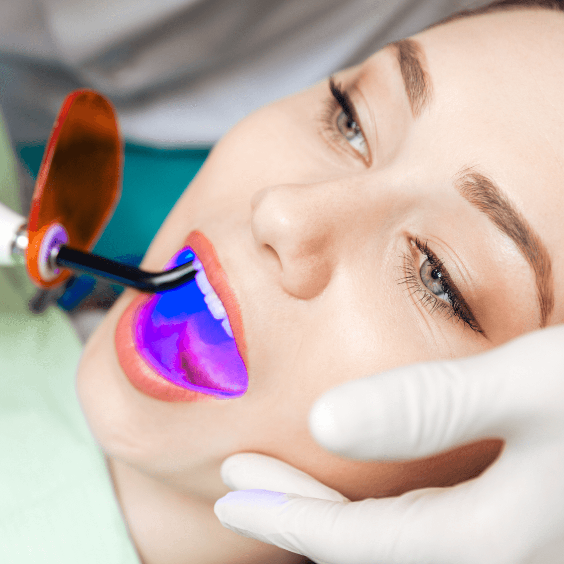 Curing light hardening tooth-colored bonding resin on a patient's teeth