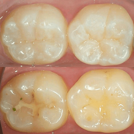 Dental sealants treatment at Canopy Dentistry