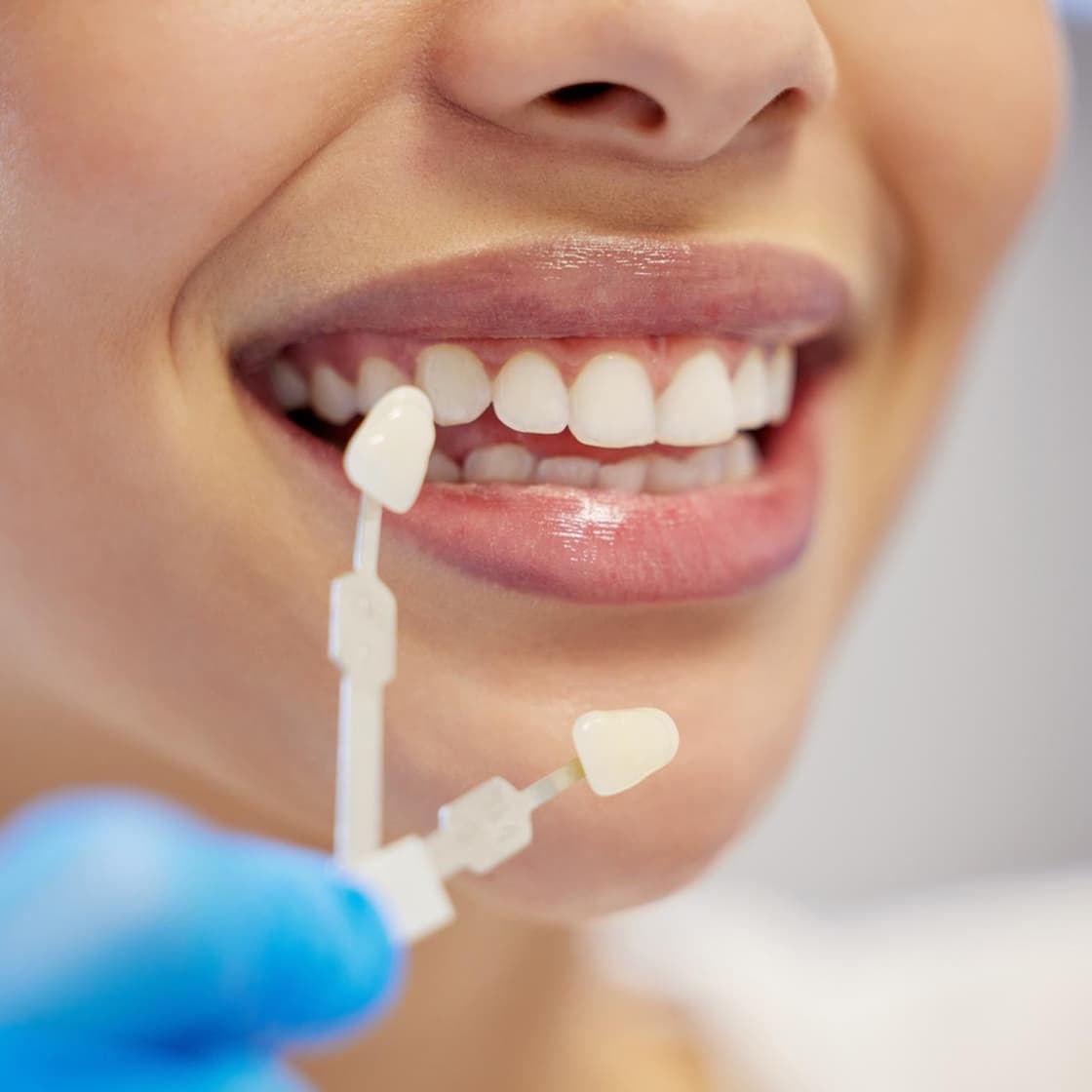 Veneer shade samples held next to a patient's smile